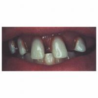 Original Billy Bob Teeth